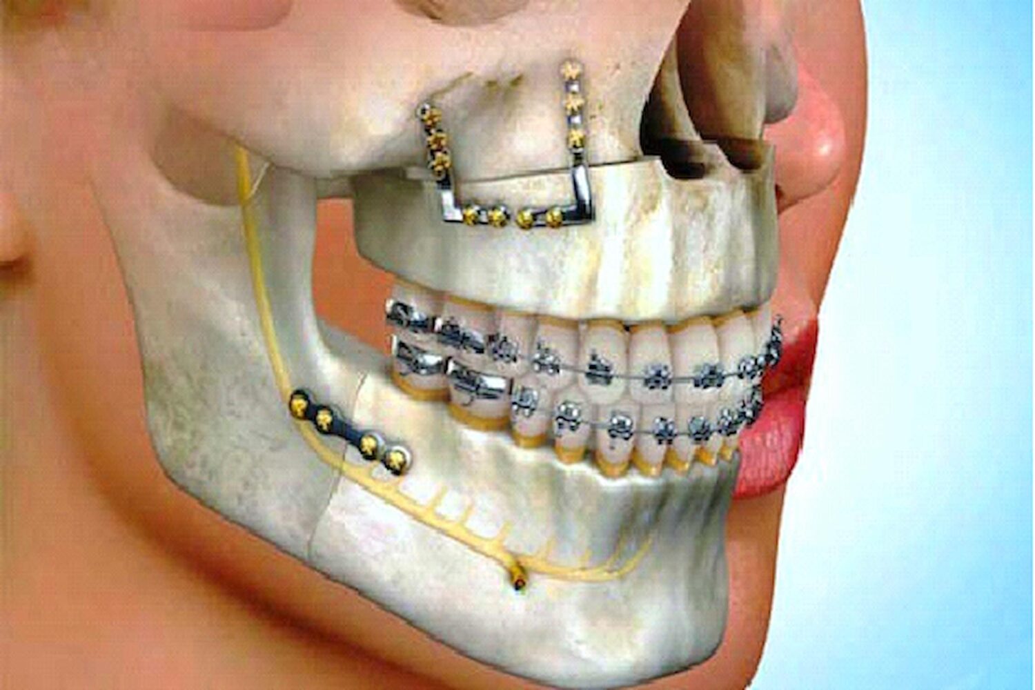 Facial-Fractures